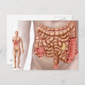 Divertikulitis in der absteigenden Kolonregion Postkarte (Vorne/Hinten)