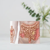 Divertikulitis in der absteigenden Kolonregion Postkarte (Stehend Vorderseite)