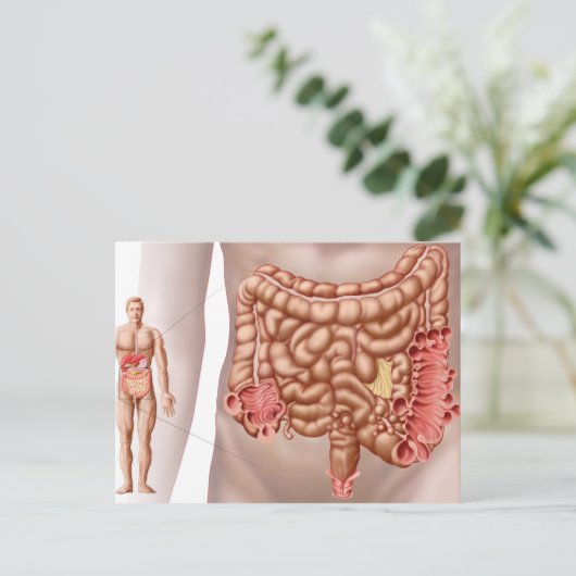 Divertikulitis in der absteigenden Kolonregion Postkarte (Stehend Vorderseite)