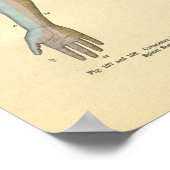 Druck am menschlichen Arm Kutane Nervenenerkrankun Poster (Ecke)