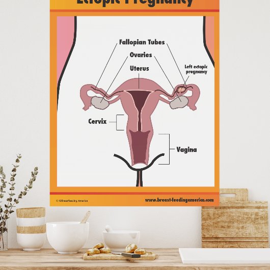 Ectopic Pregnancy Poster (Küche)