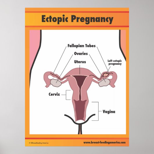 Ectopic Pregnancy Poster (Vorne)