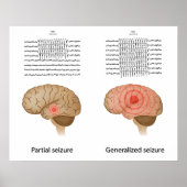 EEG bei partieller und genereller Epilepsie Poster (Vorne)