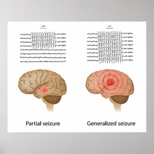 EEG bei partieller und genereller Epilepsie Poster