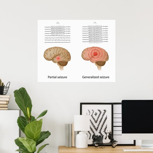 EEG bei partieller und genereller Epilepsie Poster (Heimbüro)