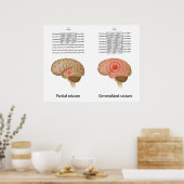 EEG bei partieller und genereller Epilepsie Poster (Küche)