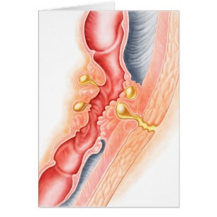 Entwicklung der Fistula