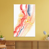 Entwicklung der Fistula Leinwanddruck (Insitu (Wohnzimmer))