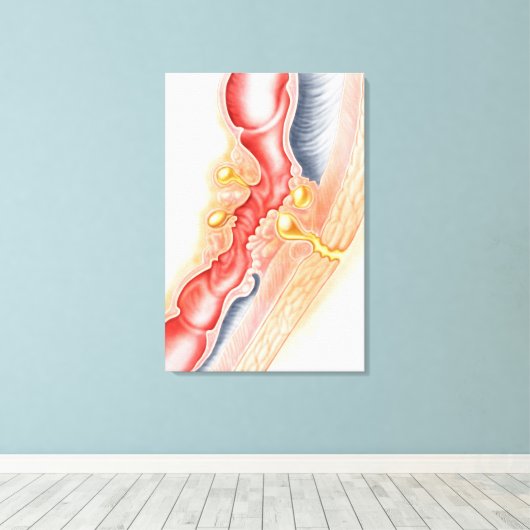 Entwicklung der Fistula Leinwanddruck (Insitu (Holzboden))