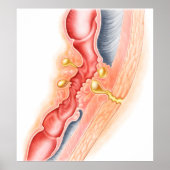 Entwicklung der Fistula Poster (Vorne)