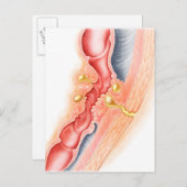 Entwicklung der Fistula Postkarte (Vorne/Hinten)