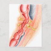 Entwicklung der Fistula Postkarte (Vorderseite)