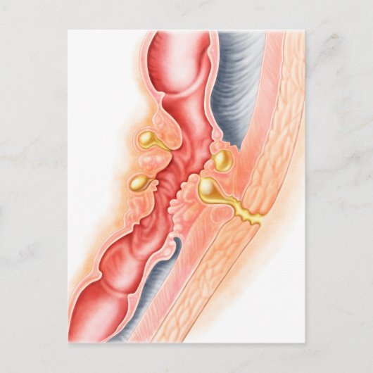 Entwicklung der Fistula Postkarte (Vorderseite)