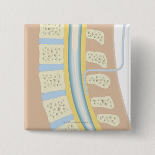 Epidurale Anästhesie Button