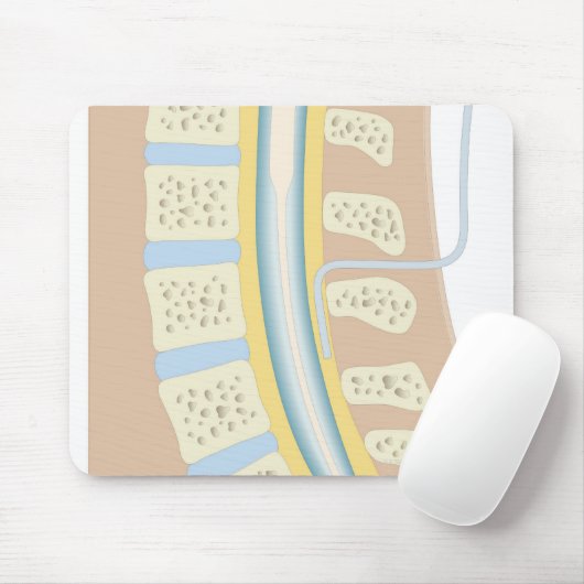 Epidurale Anästhesie Mousepad (Mit Mouse)