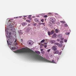 Epithelioides Uvealmelanom Krawatte
