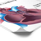 Erkrankungen des Herzmuskelposters Poster (Ecke)