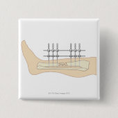 Externer Fixator Button (Vorderseite)