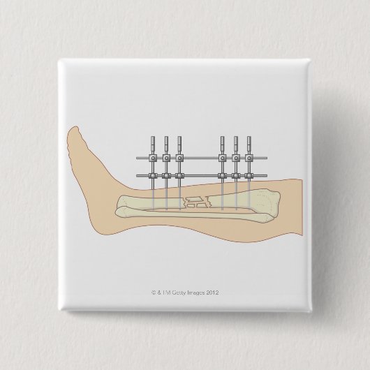 Externer Fixator Button (Vorderseite)