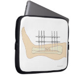 Externer Fixator Laptopschutzhülle (Vorne Rechts)