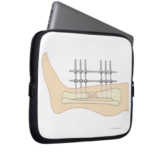 Externer Fixator Laptopschutzhülle (Vorne Rechts)