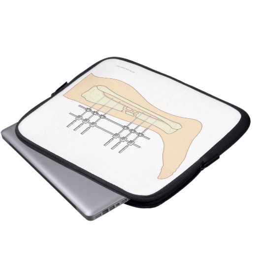 Externer Fixator Laptopschutzhülle (Vorne Knopf)