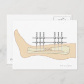 Externer Fixator Postkarte (Vorne/Hinten)