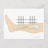 Externer Fixator Postkarte (Vorderseite)