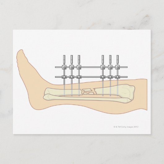 Externer Fixator Postkarte (Vorderseite)