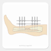Externer Fixator Quadratischer Aufkleber (Vorderseite)