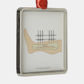 Externes Fixator Silbernes Ornament (Rechts)