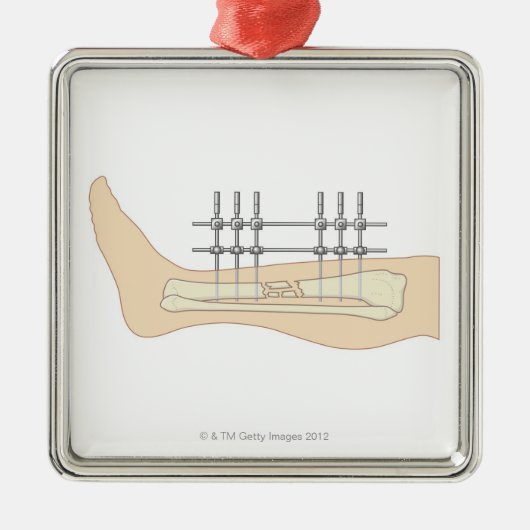 Externes Fixator Silbernes Ornament (Vorne)