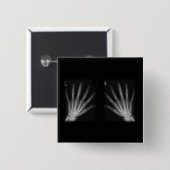 Extra-Digit-Röntgen-rechte und Links Hände Button (Vorne & Hinten)