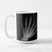 Extra-Digit-Röntgen-rechte und Links Hände Kaffeetasse (Links)