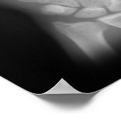 Extra-Digit-Röntgen-rechte und Links Hände Poster (Ecke)