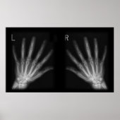 Extra-Digit-Röntgen-rechte und Links Hände Poster (Vorne)