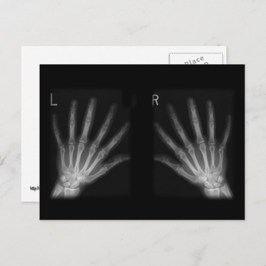 Extra-Digit-Röntgen-rechte und Links Hände Postkarte (Vorne/Hinten)
