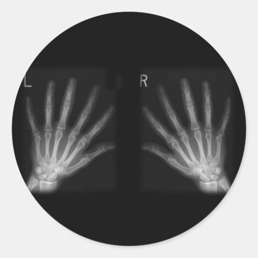 Extra-Digit-Röntgen-rechte und Links Hände Runder Aufkleber (Vorderseite)