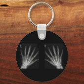 Extra-Digit-Röntgen-rechte und Links Hände Schlüsselanhänger (Vorderseite)