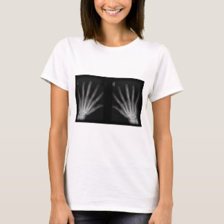 Extra-Digit-Röntgen-rechte und Links Hände T-Shirt