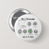 Fibromyalgia ist wirklich. fMRI Beweis Button (Vorne & Hinten)