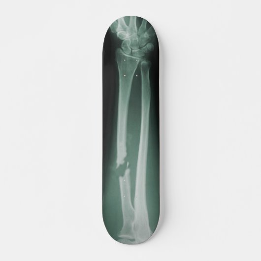 Gebrochene Knochen Skateboard (Vorne)