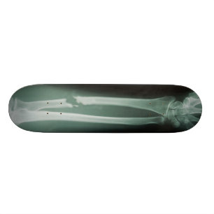 Gebrochene Knochen Skateboard