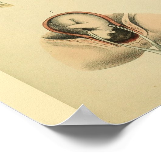 Geburtsforceps Obstetrics Anatomie Medizin Art Pri Poster (Ecke)