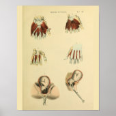 Geburtsforceps Obstetrics Anatomie Medizin Art Pri Poster (Vorne)