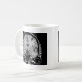 Gehirn MRI, Kranzscheibe Kaffeetasse (Vorderseite Links)