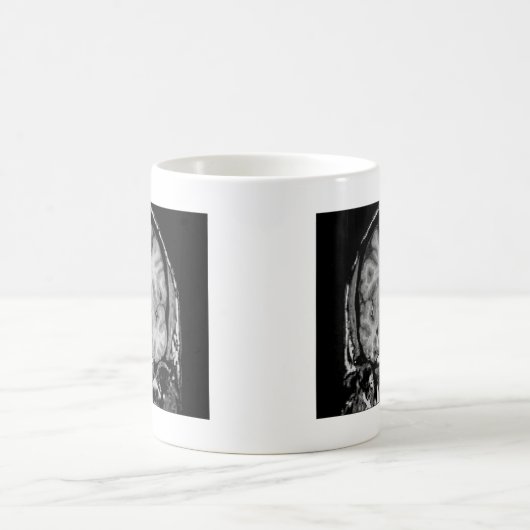 Gehirn MRI, Kranzscheibe Kaffeetasse (Mittel)