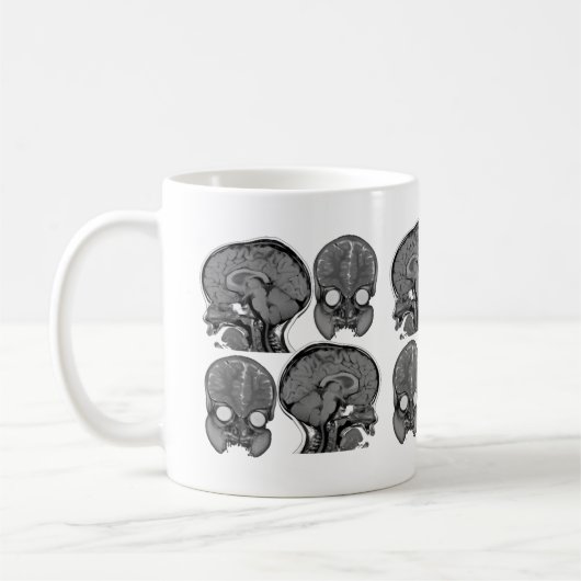 GEHIRNE! (MRI) KAFFEETASSE (Links)