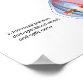 Glaukom-Poster Poster (Ecke)