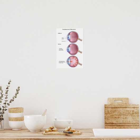 Glaukom-Poster Poster (Küche)